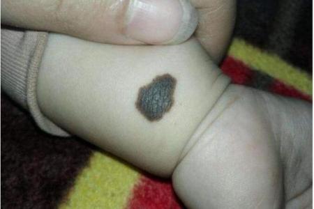 面部上的胎记算命分析
