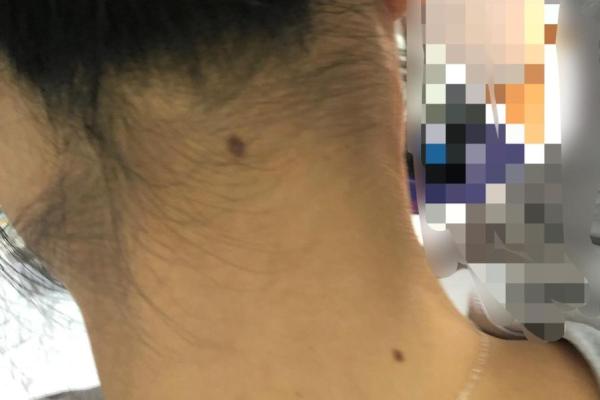 风水上女生脖子后面有痣代表什么啊