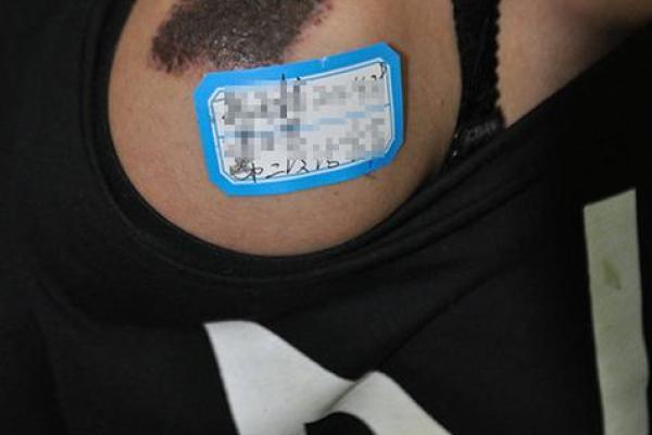 算命黑色胎记