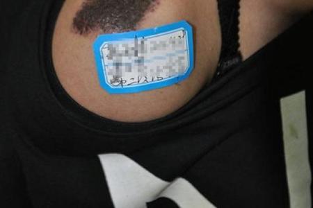 算命黑色胎记