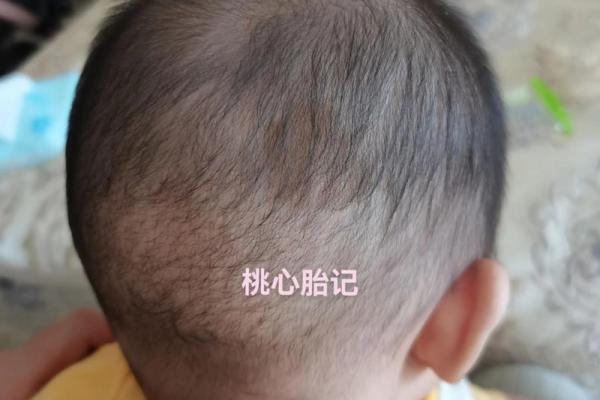 额头胎记算命