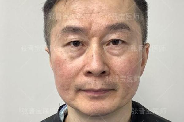 八字眼袋