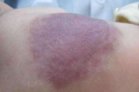 后背胎记算命