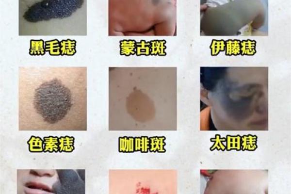 胎记如何算命-