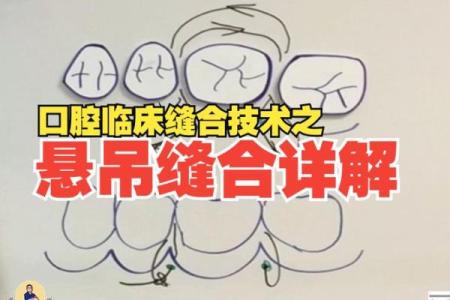 八字缝合